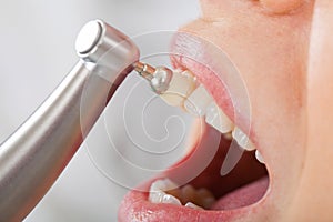 Professional dental cleaning