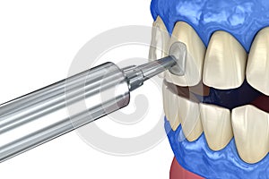 Professional teeth whitening. Adding gel over teeth. 3D illustration concept