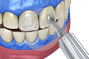 Professional teeth whitening. Adding gel over teeth. 3D illustration concept
