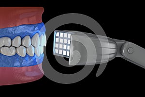 Proffesioinal teeth whitening, light-activation on tooth bleaching. 3D illustration concept