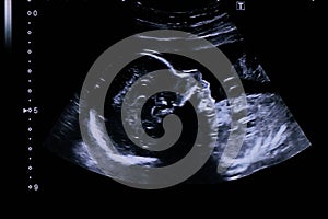 Profile of the 20 weeks old baby fetus face and chest during a halfway ultrasaound examination