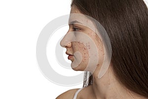 Profile of teenage girl with problematic skin