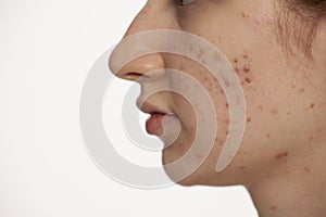 Profile of teenage girl with problematic skin