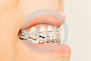 Profile view of braces for orthodontic treatment photo