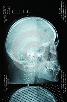 Profile view with a human skull X Ray