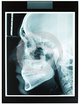 Profile xray of man jaw for dentist photo