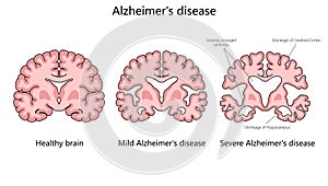 Progression of Alzheimer Disease in Brain diagram