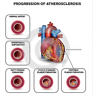 Progression of Atherosclerosis