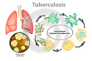 Progression of pulmonary tuberculosis