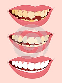 Progressive Stages Of Tooth Decay caries