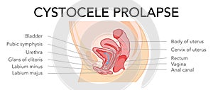 Prolapse cystocele Female reproductive system uterus with inscriptions text. Side view Human anatomy internal organs