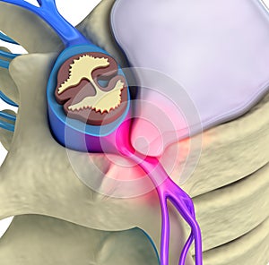 Prolapse of intervertebral disc