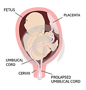 Prolapsed umbilical cord. umbilical cord comes out of the uterus with or before the presenting part of the baby photo