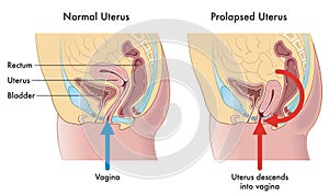 Prolapsed uterus photo