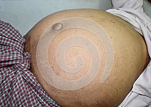Prominent abdominal distension in Southeast Asian, Myanmar man. Left lateral view.