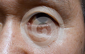 Prominent fat bag and wrinkles under eye of Asian elder man photo