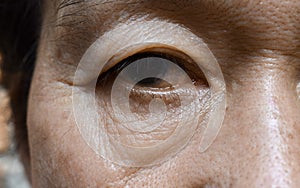Prominent fat bag and wrinkles under eye of Asian elder man photo
