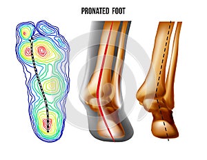 Pronated foot, arch deformation, bottom and back view . Foot weight distribution. photo