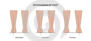 Pronation, overpronation and supination