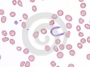 Proplatelet in the Peripheral Blood.