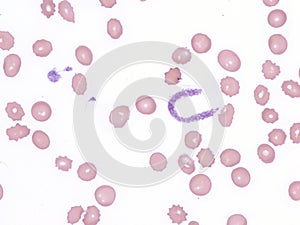 Proplatelet in the Peripheral Blood. photo