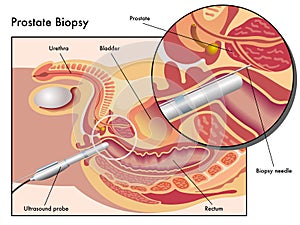 Prostate biopsy photo