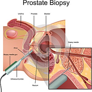 Prostate Biopsy