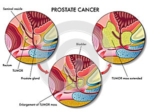 Prostate Cancer photo