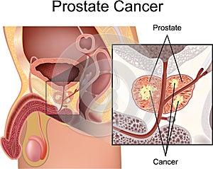 Prostate Cancer photo