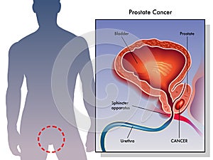 Prostate Cancer