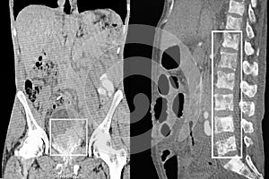 Prostate cancer, bone metastases. CT-scan reconstruction. photo