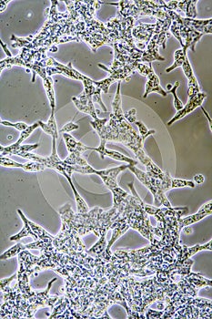 Prostate Cancer cells