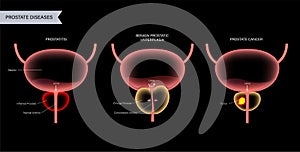 Prostate cancer concept