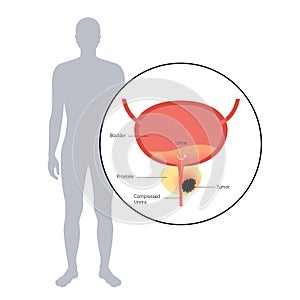 Prostate cancer concept