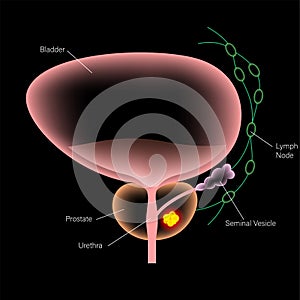 Prostate cancer concept