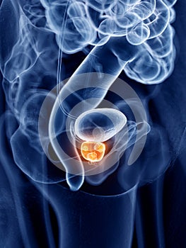Prostate cancer
