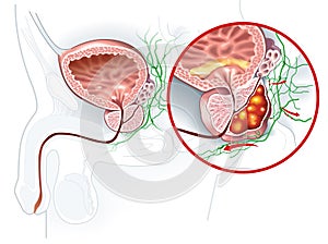 Prostate cancer and healthy prostate, medically accurate illustration photo