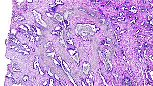 Prostate cancer of a human photo