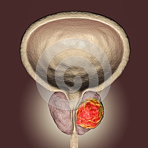 Prostate cancer illustration