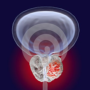 Prostate cancer illustration