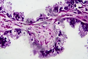 Prostate cancer, light micrograph