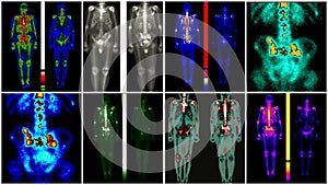 Prostate cancer metastasis photo