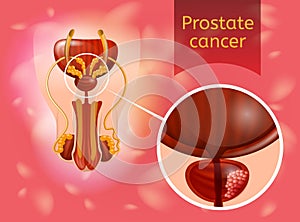 Prostate Cancer Realistic Vector Anatomical Scheme