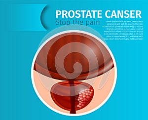 Prostate Cancer. Stop the Pain Urological Banner.