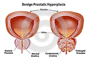 Prostate Enlarged with Benign Hyperplasia photo