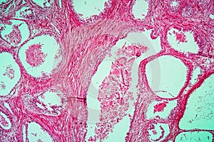 Prostate enlargement diseased tissue