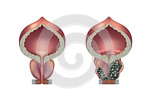 The prostate is normal and with adenoma.