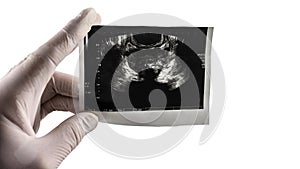 Prostate ultrasound scan on isolated white background, picture of the prostate at the doctor`s hand. Prostata place for text