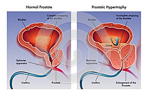 Prostaty hypertrofia 