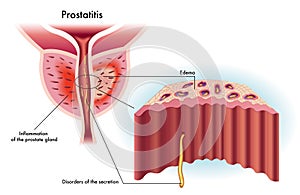 Prostatitis photo
